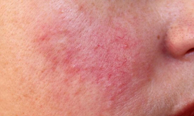 ROSACEA: Diffus rødhet, kviseliknende utslett og telangiektasier i kinn hos pasient med rosacea. FOTO: NTB Scanpix / Shutterstock / Dermatology11 ROSACEA: Diffus rødhet, kviseliknende utslett og telangiektasier i kinn hos pasient med rosacea. FOTO: NTB Scanpix / Shutterstock / Dermatology11
